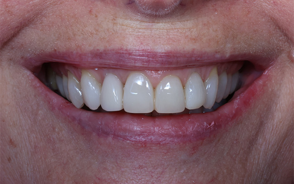 10-after