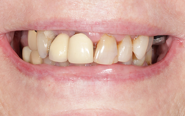 13-before