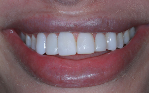 5-after