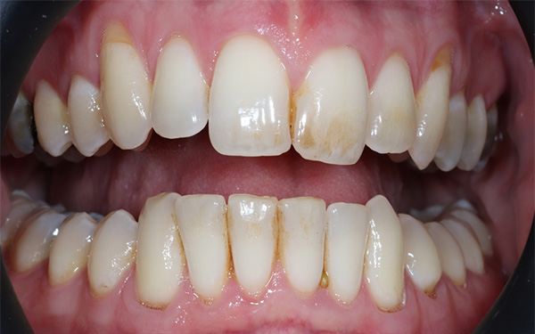 7-before
