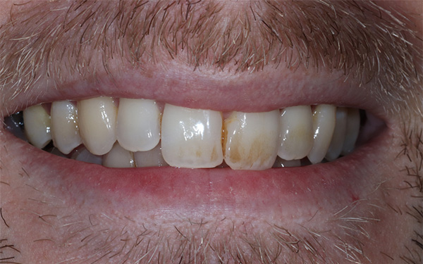 8-before