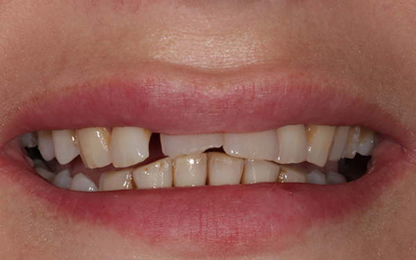 9-before