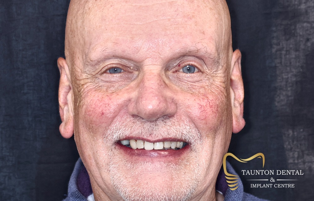 andrew-hobbs-face-h-after